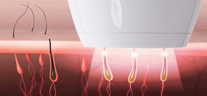 IPL technológia működése IPL technológia működése