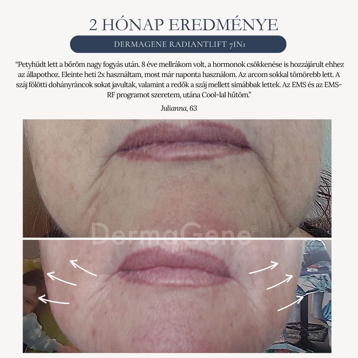 dermagene radiant lift előtte-utána képek dermagene radiant lift előtte-utána képek