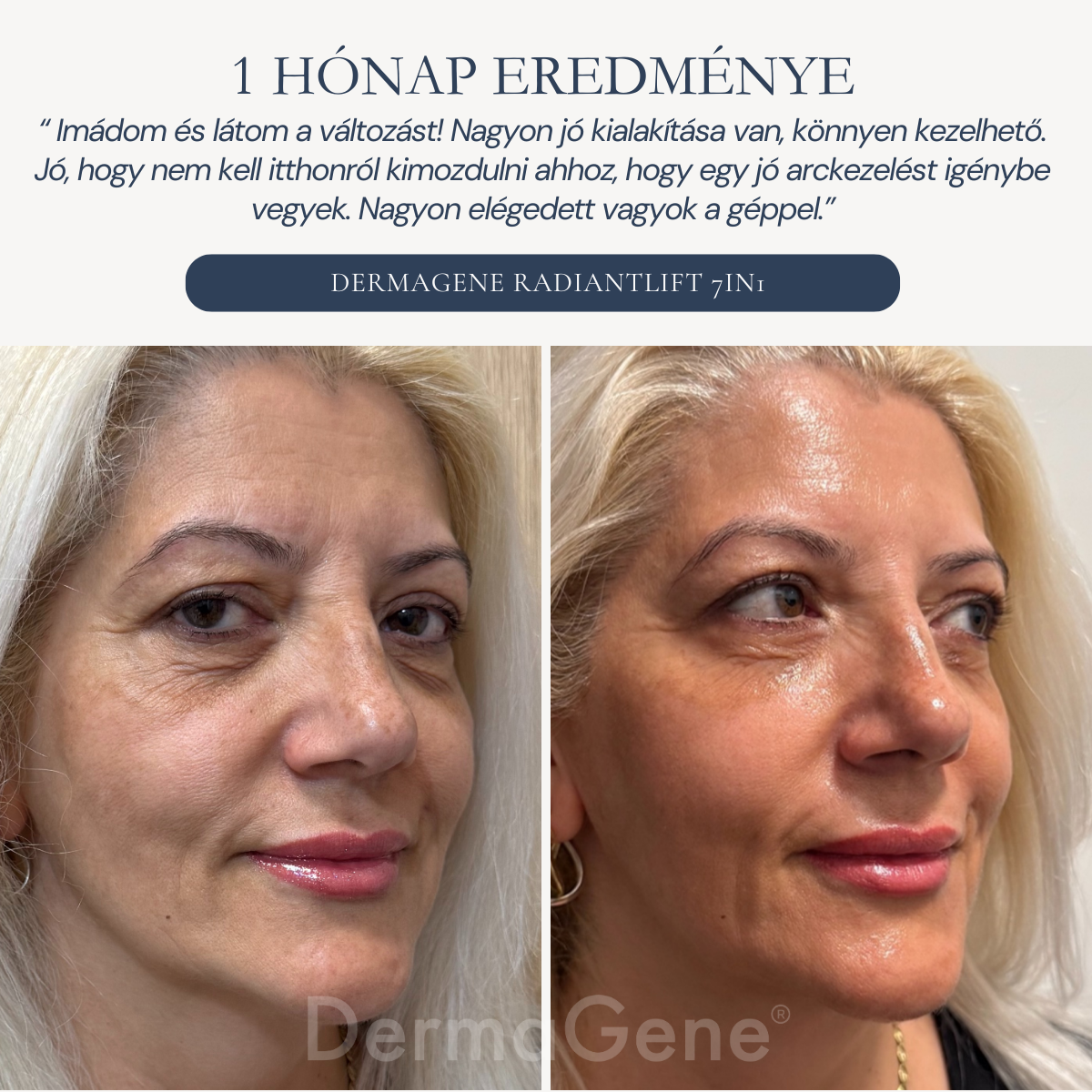 dermagene radiant lift előtte-utána képek dermagene radiant lift előtte-utána képek