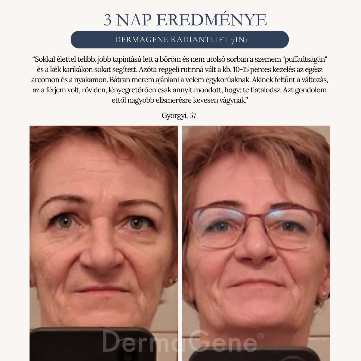 dermagene radiant lift előtte-utána képek dermagene radiant lift előtte-utána képek